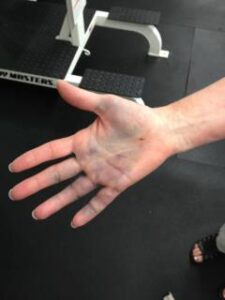 photo of bruised hand